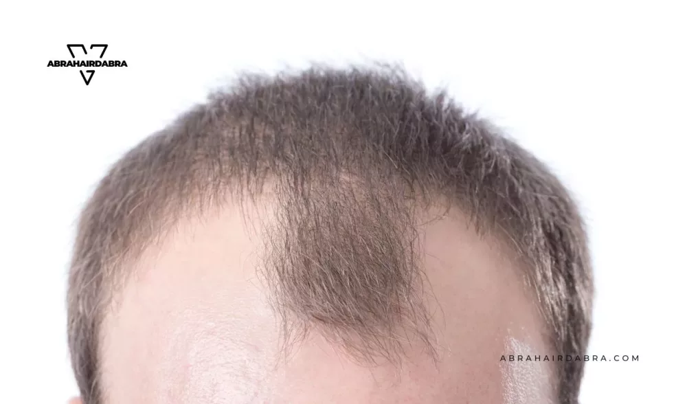 Do hairpieces also help against receding hairlines?